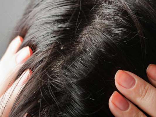 How To Treat Dandruff With Coconut Oil