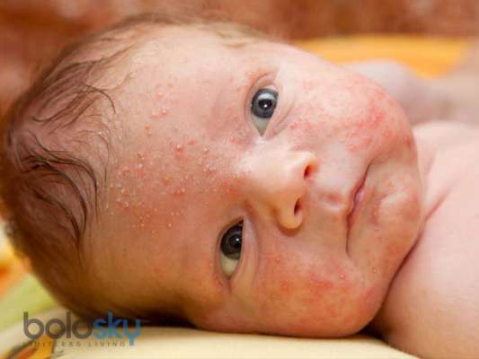 White Skin Patches In Children – What Could It Mean?