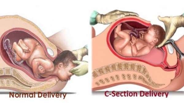 Can I Have A Normal Delivery After C Section?