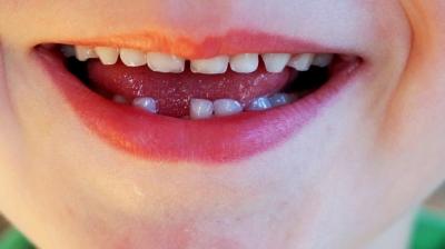 Children’s teeth can predict their mental health