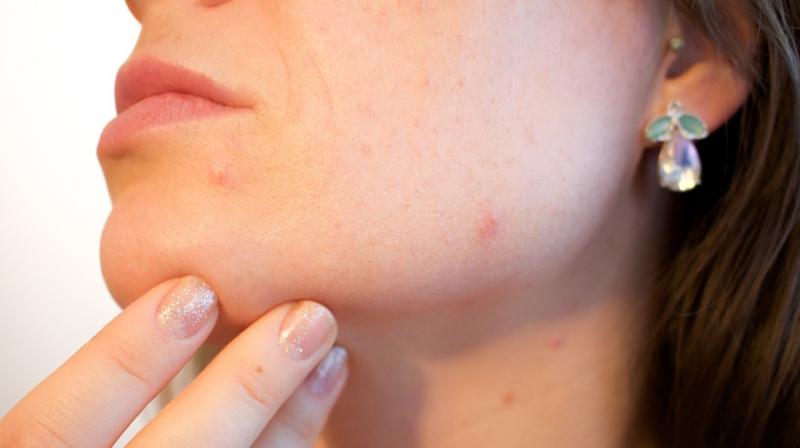 Acne stigma linked to lower overall quality of life: Study